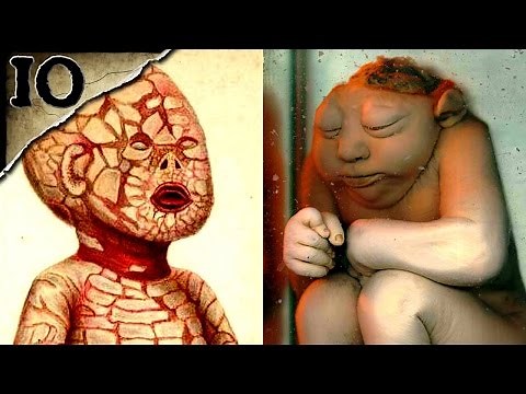 10 Horrible Birth Defects | TWISTED TENS #17