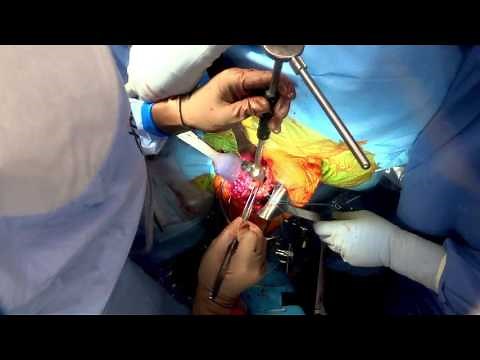 Total Shoulder Replacement Surgery