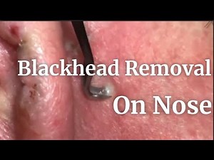Blackhead Removal On Nose | Pimple Spa
