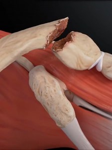 2.9K views · 25 reactions | Phẫu thuật gãy xương đòn | Doctor Plus | Facebook