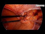Laparoscopic Inguinal Hernia Repair in Female • Video • MEDtube.net