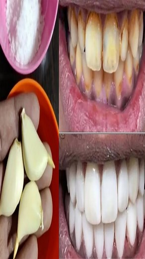 2.5K views · 38 reactions | Garlic and toothpaste for teeth whitening殺殺 teeth## whitening## garlic for teeth whitening · Soak the garlic clove in milk for around 30 minutes. Then mash it well, add olive oil and mix everything well.殺殺 | ELEGANT BEAUTY | Facebook