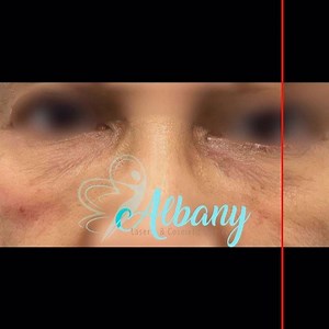 #undereyefiller | Albany Cosmetic & Laser Centre | Facebook