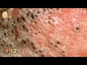 San Jose #92: Blackheads &Whiteheads