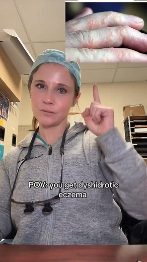 Dyshidrotic eczema (aka pompholyx) is small, itchy blisters on hands and feet. They are typically triggered by stress, sweating, irritant or allergen exposure (including nickel, fragrance, rubber). Regular moisturizer and avoiding allergens helps but see a dermatologist for severe cases. What triggers your dyshidrotic eczema? #dyshidroticeczema #eczema #dermatologist | Dick Clark American Bandstand