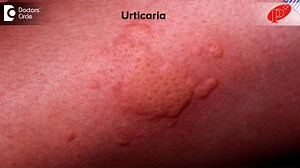 1K views | Clustered red spots on back, near chin and the eye swelling, it clearly indicates an allergy, probably urticarial. We have to rule out insect bite allergy, food allergy or contact allergy. So you need to take a proper history in these people to identify the allergen. Avoid the allergen, take anti allergics, and you will settle down. | Doctors' Circle | Facebook