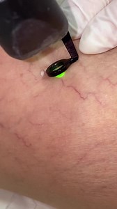 Christmas is here! #enjoyit #Christmas #spiderveins LASER SPIDER VEINS REMOVAL Soft & Smooth legs ONLY €209 Until 11/12 You can prepay! ☎️Call at. 22871110 #veinspecialist #veinsremoval #spiderveinsremoval #veins #veinspopping #dcdermatologicum #nicosia #skincare #DC #dermatologicum #skinismorethanskin #skinsmoothing | DC Dermatologicum | Facebook