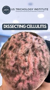 Dissecting Cellulitis, The Intricacies of Skin Inflammation . . . #HairLoss #Alopecia #HairTransplant #HairGrowth #ThinningHair #HairRestoration #Baldness #HairLossTreatment #HairLossSolutions #Balding | United States Trichology Institute