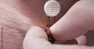 A surgeon uses an electric knife to remove a papilloma from an animal in a veterinary clinic. In surgery, the doctor removes a papilloma on the dog's body. Removal of a benign tumor from an animal.