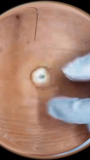 Ultimate Blackhead and Cyst Squeezing Compilation