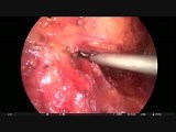 Lap Anterior Resection with Hernia • Video • MEDtube.net
