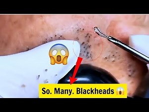 Clearing Hidden Blackheads Under the Chin – So Satisfying!