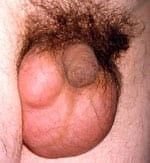 Hydrocele Aspiration & Sclerotherapy Specialist - Los Angeles