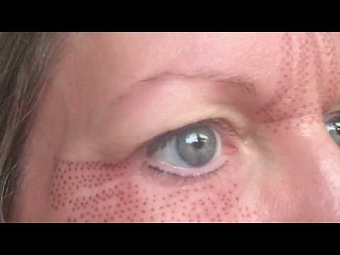 Plasma Blast 1st Treatment (Fibroblast) Lower Eye Area