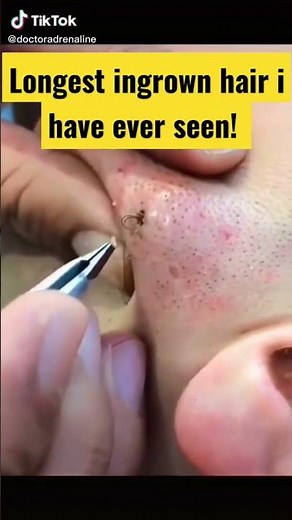 LONGEST ingrown hair 😱 popping HUGE blackheads and pimples | pimple popper | | cyst & acne