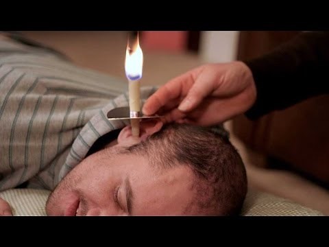 The danger of ear candling