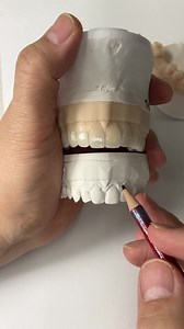 17 reactions | Upper Diagnostic Wax-Up! Case from Dr. Jared Bowyer in Washington State! EnvisionTEC | Luke Kahng | Facebook