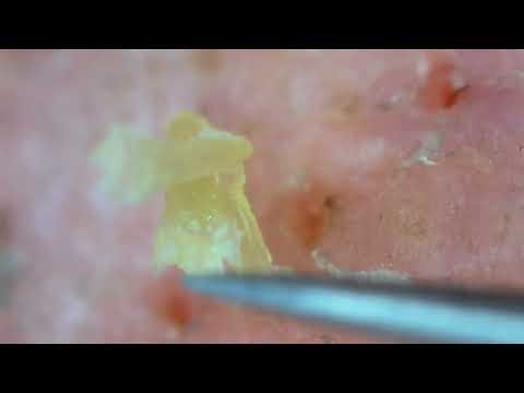 0291 keratin plug removal nose