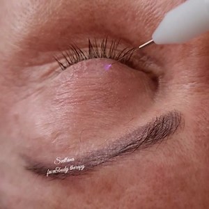 Does cold plasma work on eyelids?-$250 COLD Plasma - is one of the quickest and safest treatment options to remove skin on the eyelid and treat hooded eyes. This 20-minute treatment performed by our in-clinic doctors reduces heavy, hooded brows and tightens the skin on the upper eyelids | Face and Body Therapy Perth Australia