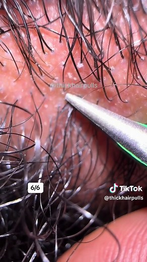 Removing Compound Hairs from Husband's Beard | Beard Plucking ASMR