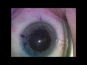 Alcon Toric IOL Insertion with Vision Blue & Malyugin Ring