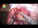 Artery preserving Laparoscopic Varicocelectomy • Video • MEDtube.net