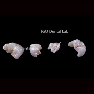 [Hot Item] All Ceramic Emax Onlay/Inlay Restoration for Small Defects Made in China Dental Lab