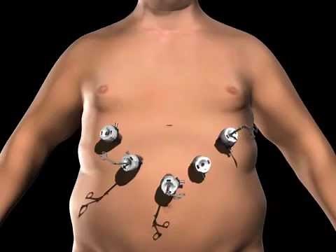 Vertical Sleeve Gastrectomy