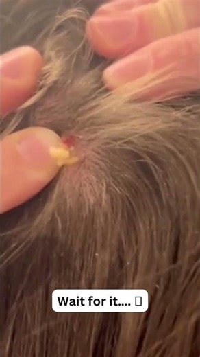 Large Blackheads Extraction Big Cystic Acne Blackheads&Whiteheads Removal Pimple Popping #1020 2026