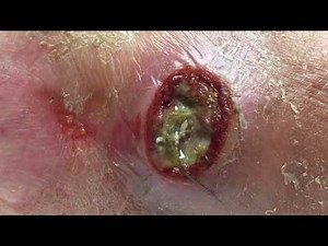 Maggots in Open Wound