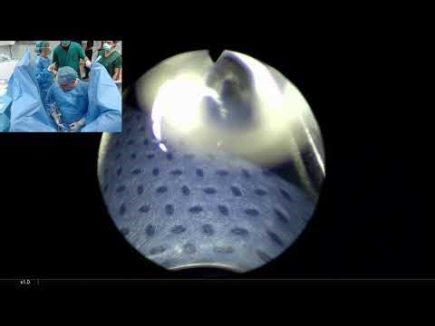 ThuFLEP- Thulium Fiber Laser Enucleation of the Prostate/Dr. Fernando Gomez Sancha