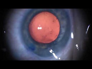 MiLoop and Bicapsular Capture