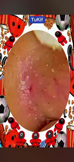 Extraction de points noirs , c est tellement satisfaisant 😁 #pourtoi #satisfyingvideos #asmrvideo #pimples #acneproneskin