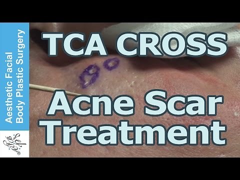 Live Surgery & Discussion with 80% Tricholoroacetic Acid - TCA CROSS for Deep Ice Pick Acne Scars