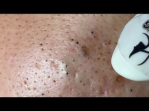 Make your Acne Treatment Huong Da Nang#517 | acne 2023