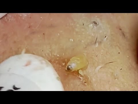 acne treatment nhat bang spa #10