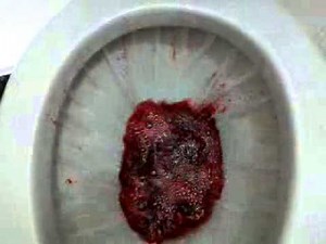 Rectal Bleeding, Diverticular Disease of the Colon in Adults ,