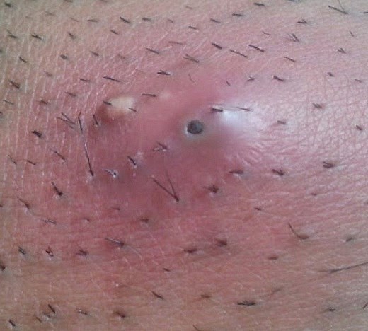 BOUTON BLANC : boutons blancs, causes, que faire en cas de point blanc? - Dr Rousseau Dermatologue  - Dermatologue en téléconsultation