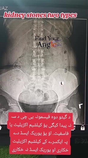 Understanding Kidney Stones: X-ray and CT Scan Insights