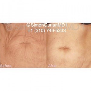 Nonsurgical Skin Tightening 😷 Treatment: USRF Skin tightening 🎯 Purpose: To tighten the dermal tissue and the skin of body like knees, abdomen, thighs, arms 👓 How it works: Using ultrasound or radio frequency skin is heated to a thermal max level which causes restructuring of collagen and elastin tissue. 🎉 Results: Noticed in 4-12weeks ✏ Note: Individual results may vary 📞 Phone: 310-746-5233 📬 Email: info@epione.com 🌍 Website: www.epionebh.com 📍 Location: Epione Beverly Hills 👏 Techniq