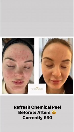 Refresh Chemical Peel Before & Afters! 🤩😮 Currently £30 for case study purposes (normally £50) | Relaxed Aroma & Beauty