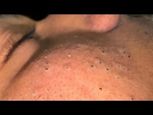 Satisfying Pimple Popping ASMR — Real Zit & Blackhead Extraction