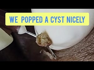 Popping out a tiny cyst near to the eye | ‪@Reframe-Health‬