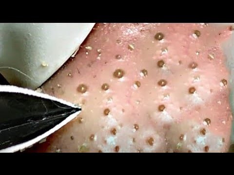Best Satisfying Nose Plucking Blackheads Whiteheads Removal | Acne Treatment #19