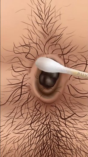 ASMR Dirt and stone removal in deep belly button| Remove Huge Navel Stone Animation | REVERSE VIDEO