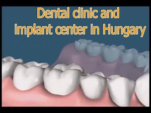 #implant #price #17dentist #dentaltourism #UKtoHungary | Eurodent Implant and Dental Center