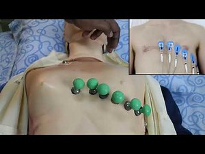 ECG leads placement