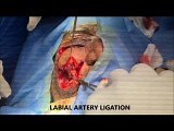 Nasolabial Flap for Face Reconstructionby • Video • MEDtube.net