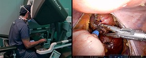 Robotic Low Anterior Resection with Diverting Loop Ileostomy for Locally Advanced Rectal Cancer | Journal of Medical Insight