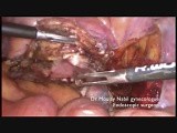 Sacrocolpopexy Using Harmonic Ace with Advanced Hemostasis • Video • MEDtube.net